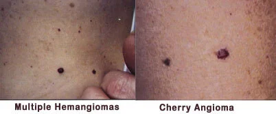 Hemangiomas ( A.K.A. Angiomas, Ruby Points Or Blood Spots)<br />
